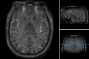 MRI ASL (Arterial Spin Labeling)