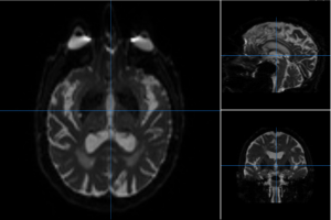 Diffusion Tensor Imaging