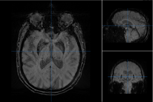 MRI SWI (Susceptibility Weighted Imaging)