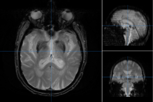 T2-weighted MRI