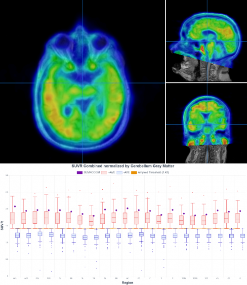 Dementia Patient determined Positive